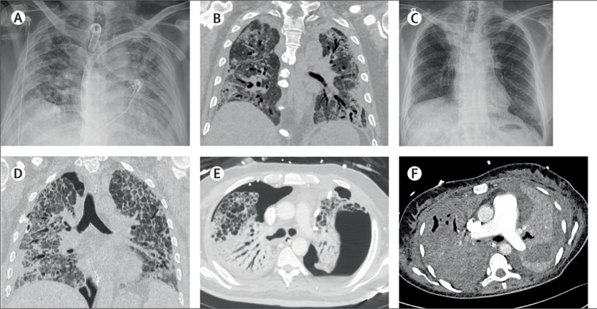 Transplantacija pluća kod COVID pacijenata u Beču